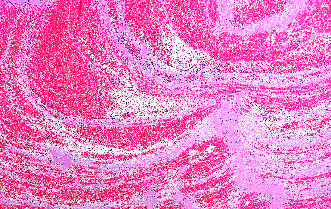 Blood clot, light micrograph