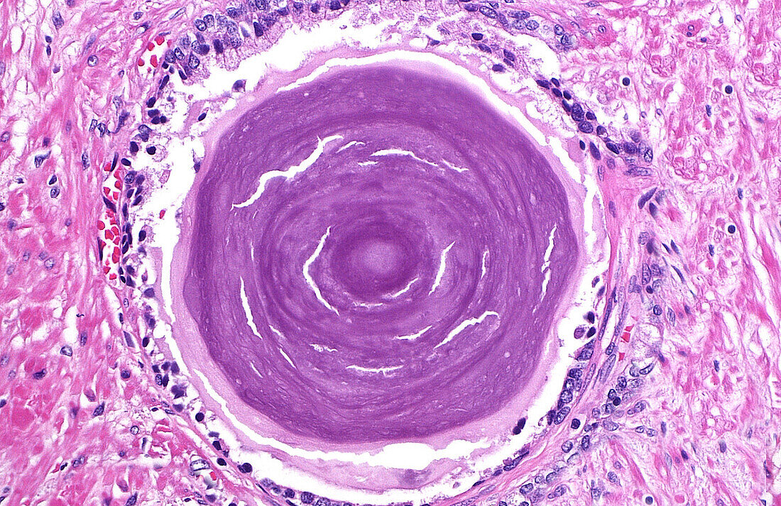 Prostate corpus amylaceous, light micrograph