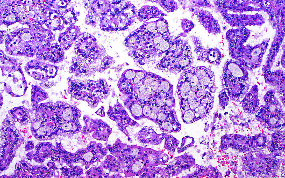 Kidney papillary cancer, light micrograph