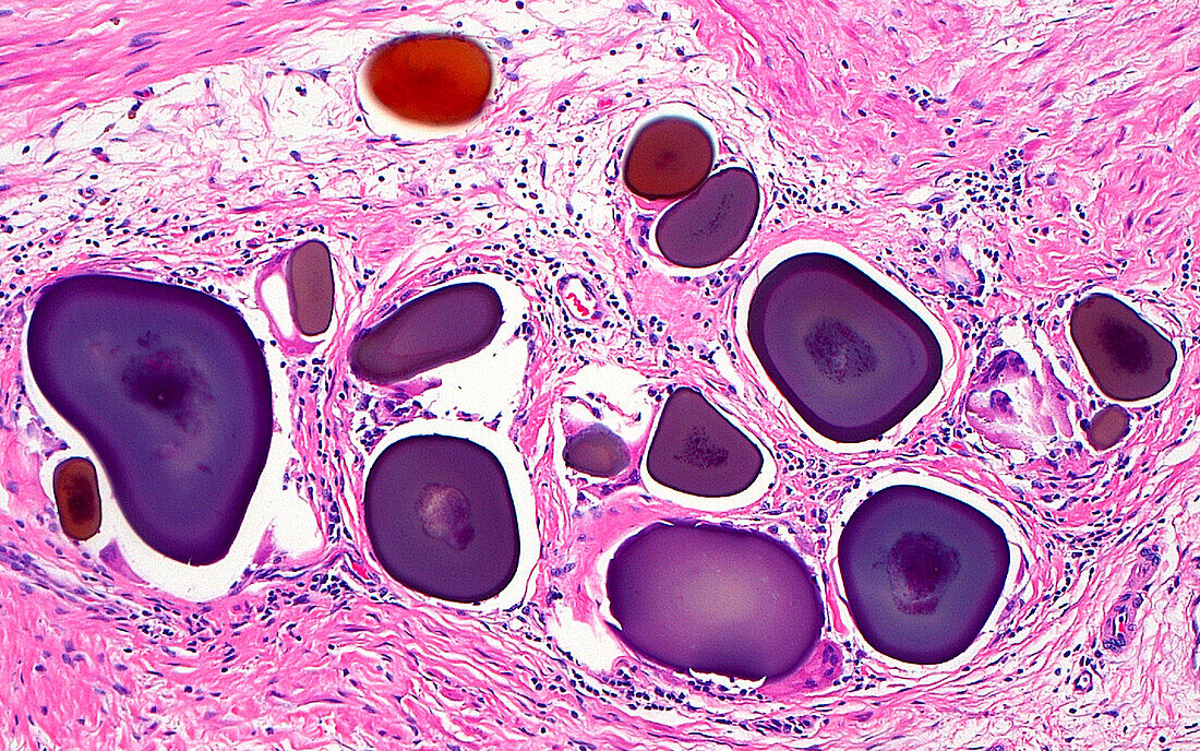 Prostate corpora amylacea, light micrograph