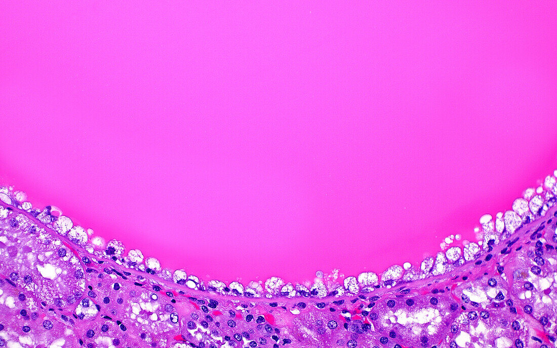 Benign kidney cyst, light micrograph
