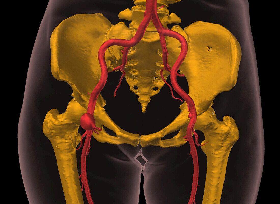 Pseudoaneurysm of the femoral artery, 3D CT scan