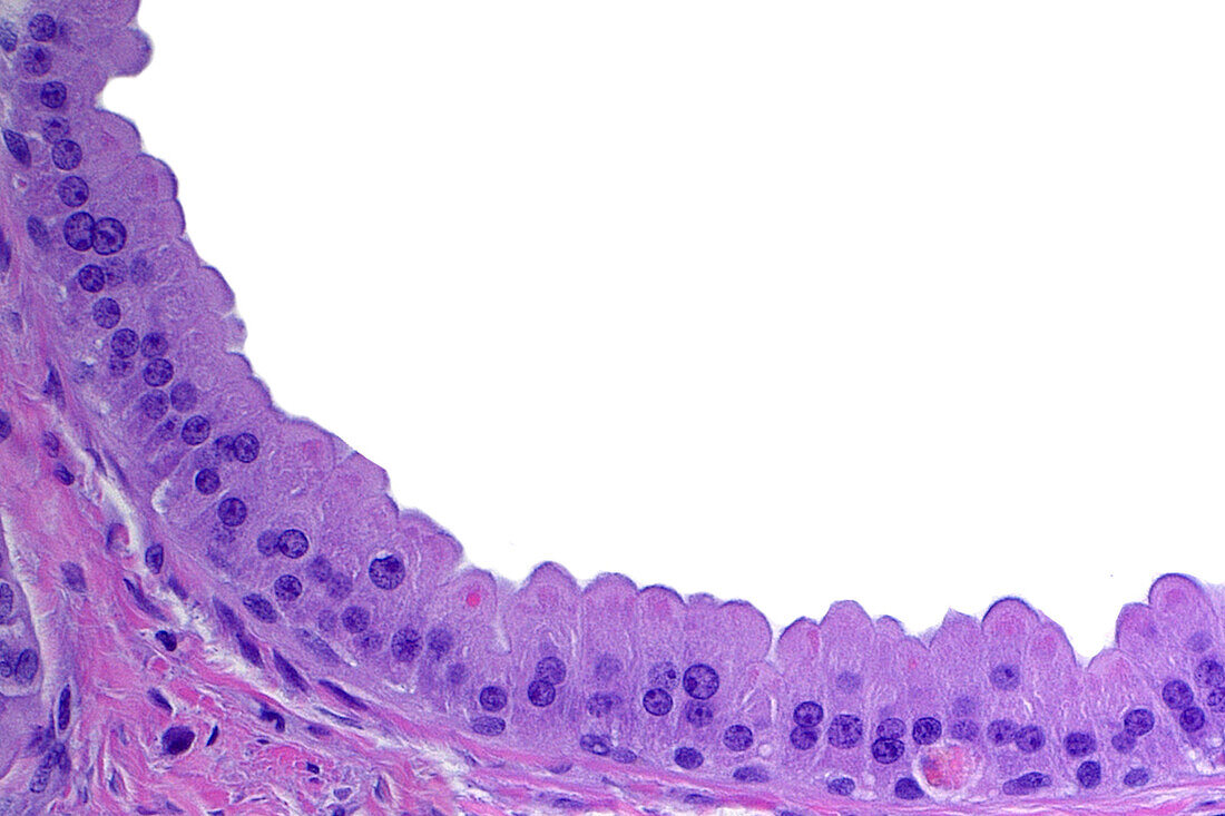 Breast apocrine metaplasia, light micrograph