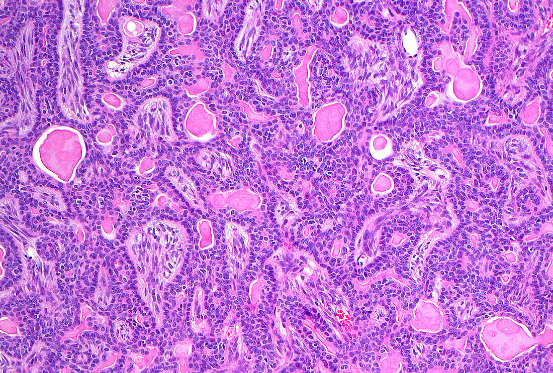 Basal cell adenoma, light micrograph