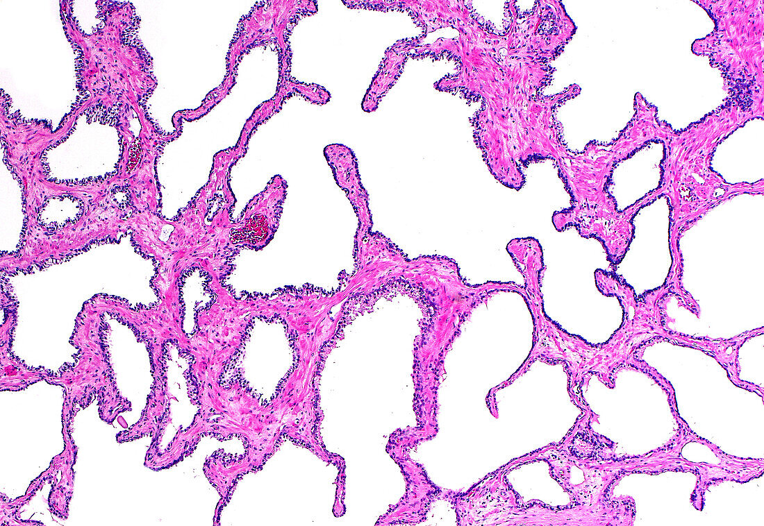 Prostate glands atrophy, light micrograph