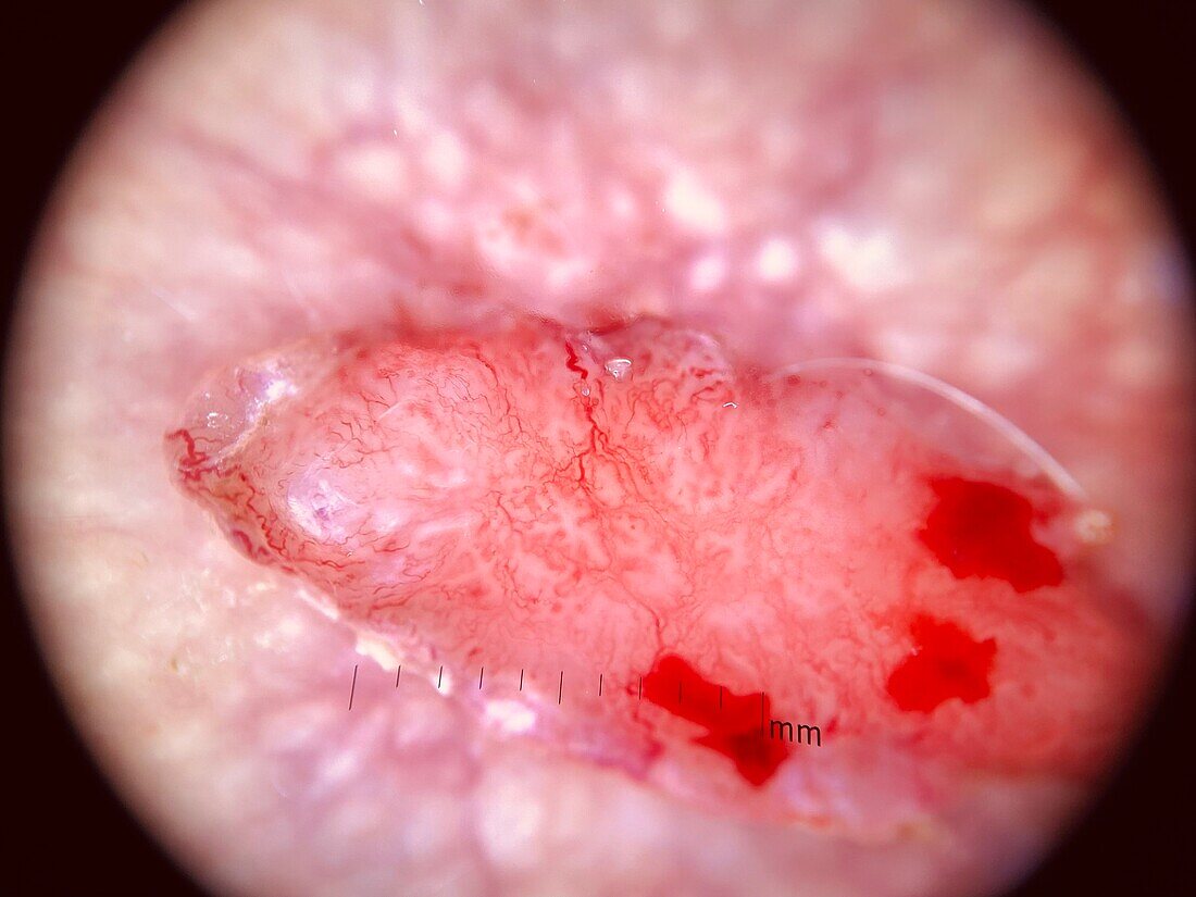 Nodular basal cell carcinoma, dermoscopy