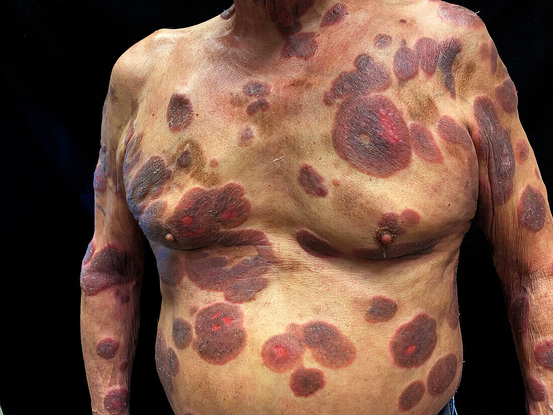 Cutaneous T-cell lymphoma