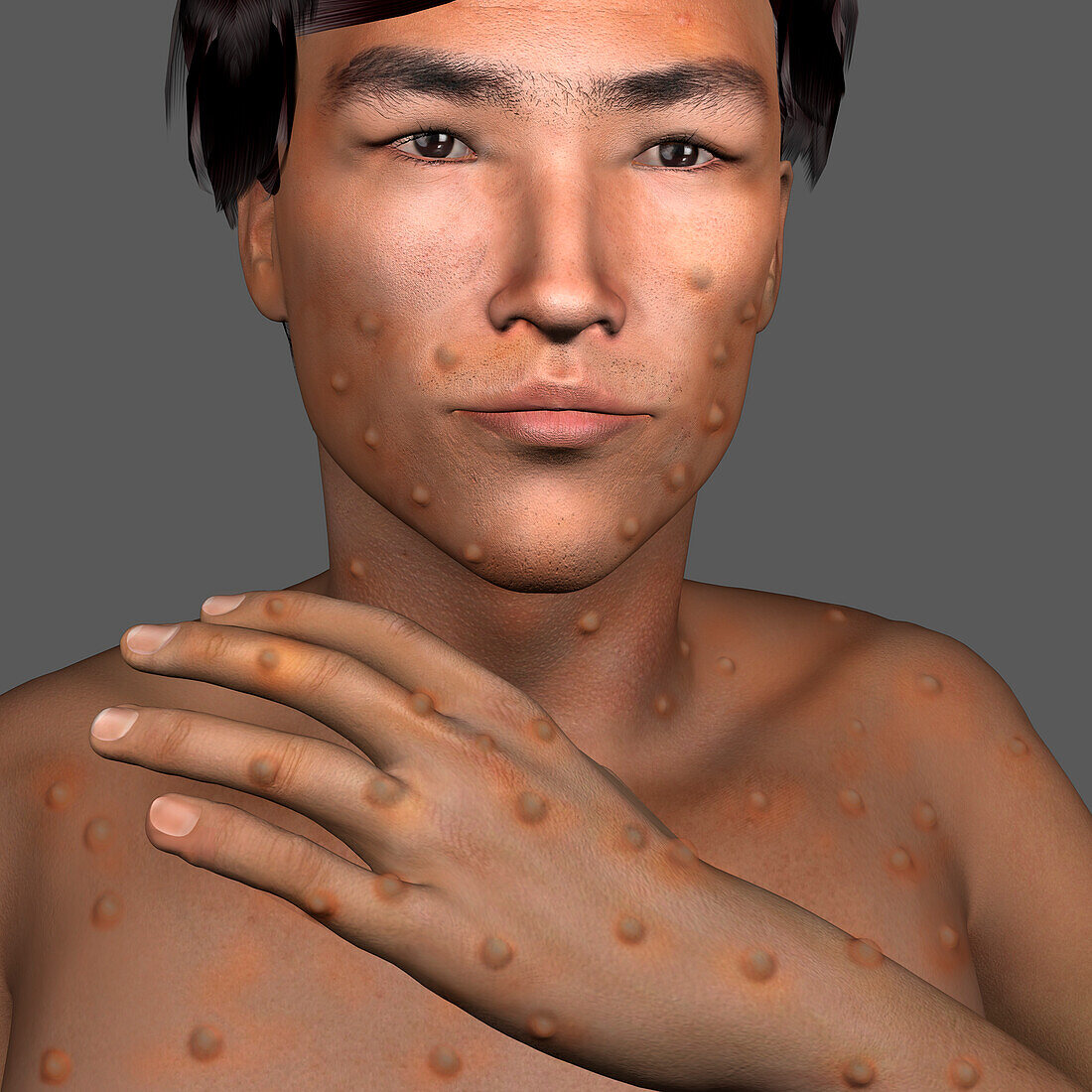 Monkeypox infection, illustration