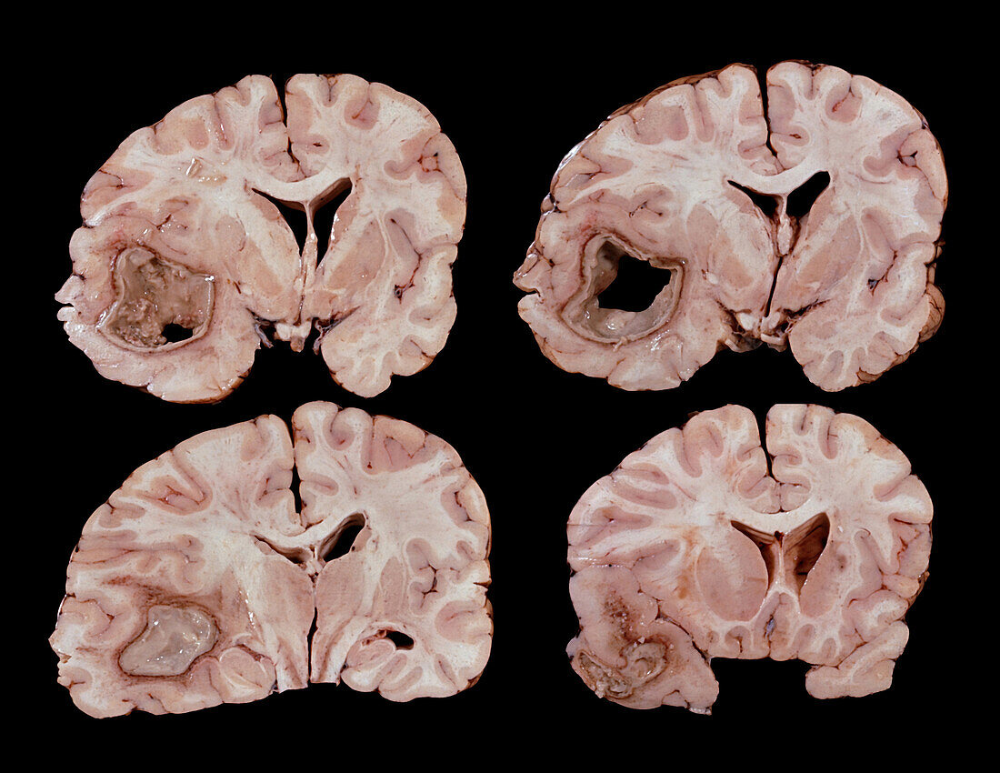 Human brain abscess