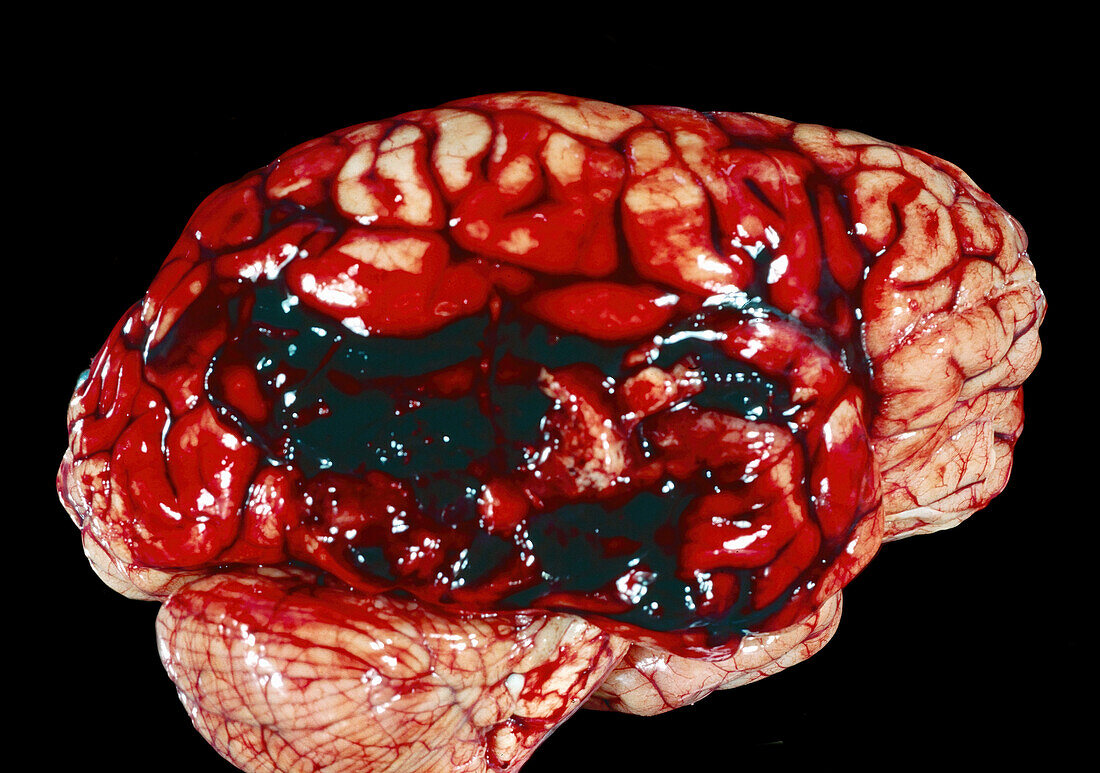 Temporal lobe stroke