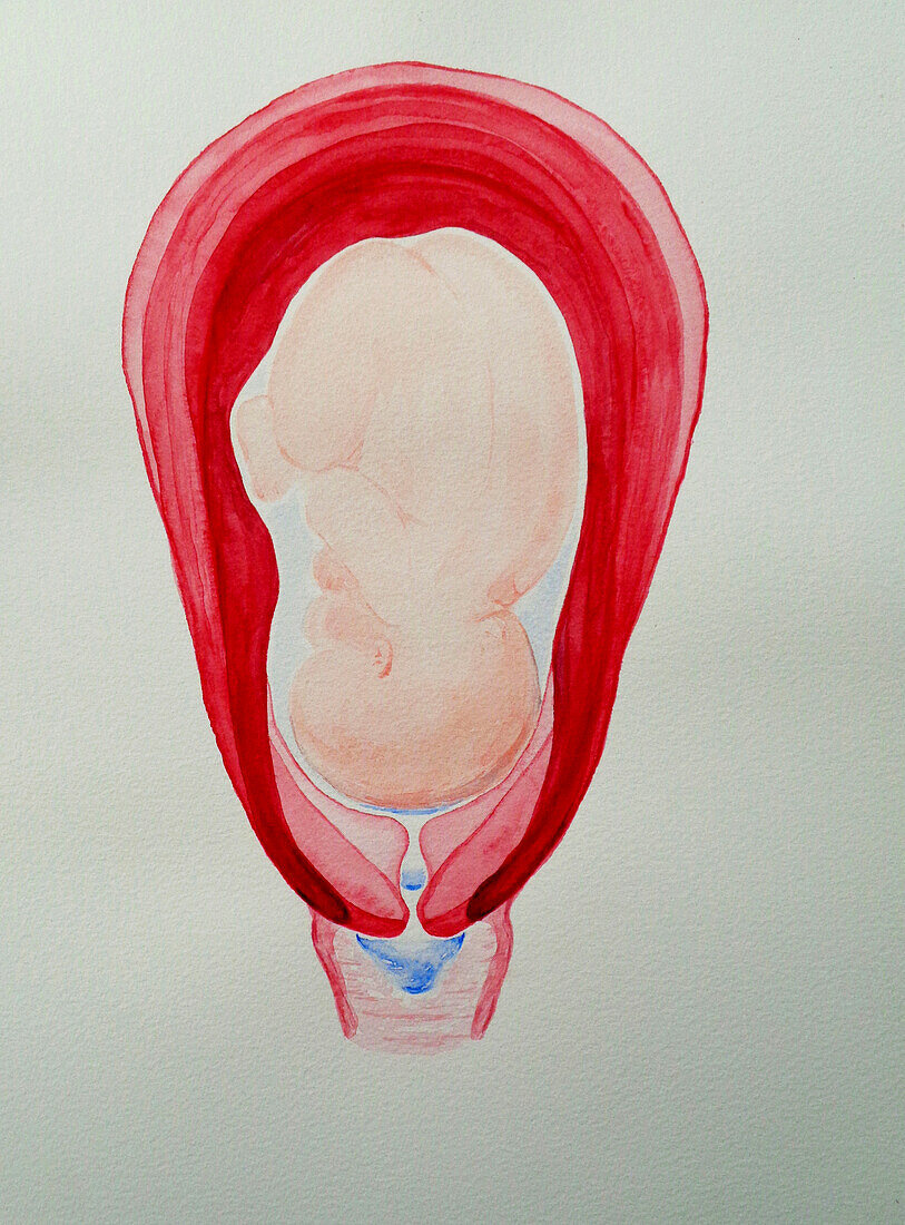 Cervical effacement and dilation, illustration