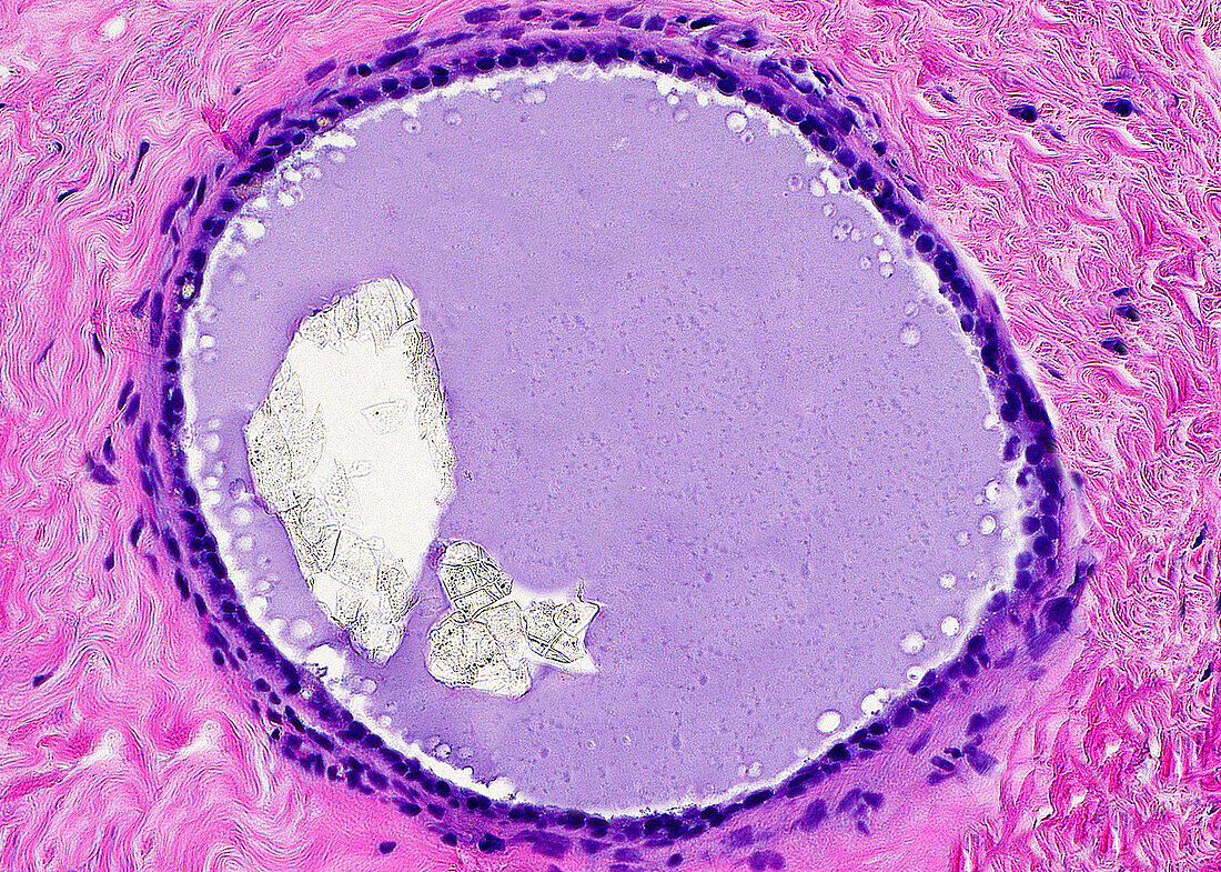 Oxalate calcification in breast biopsy, light micrograph