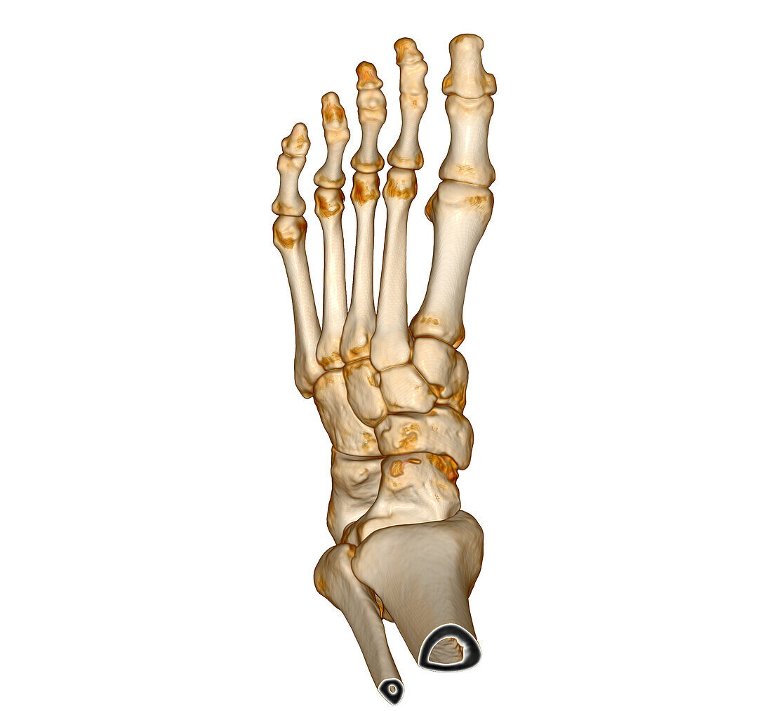 Foot, 3D CT scan