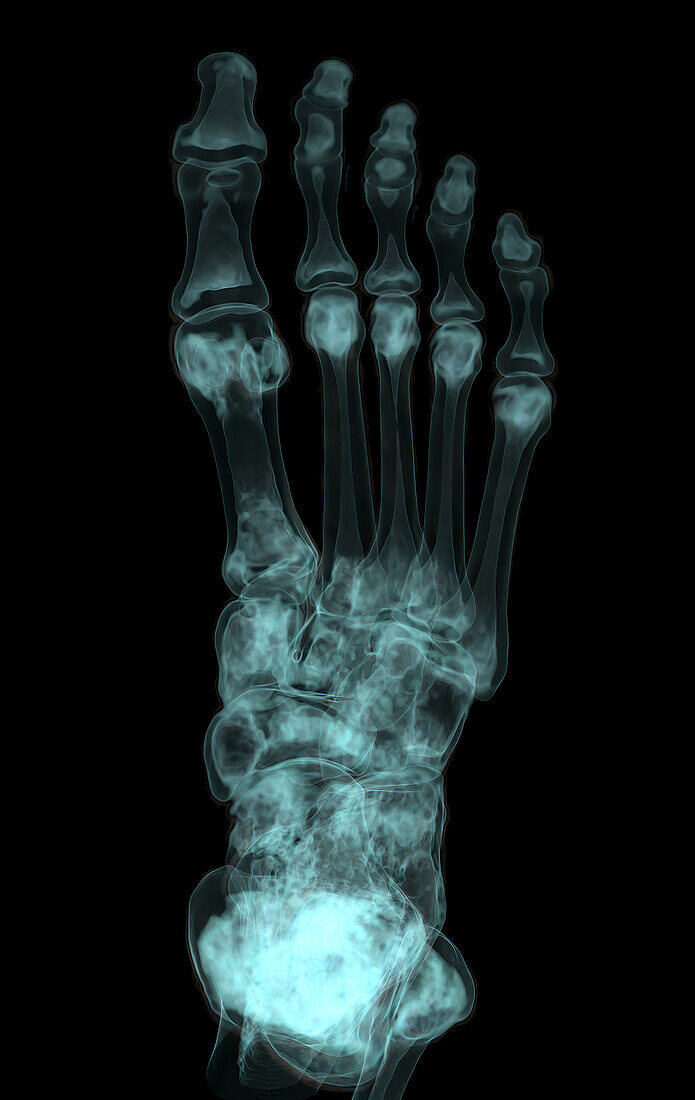 Foot, CT scan