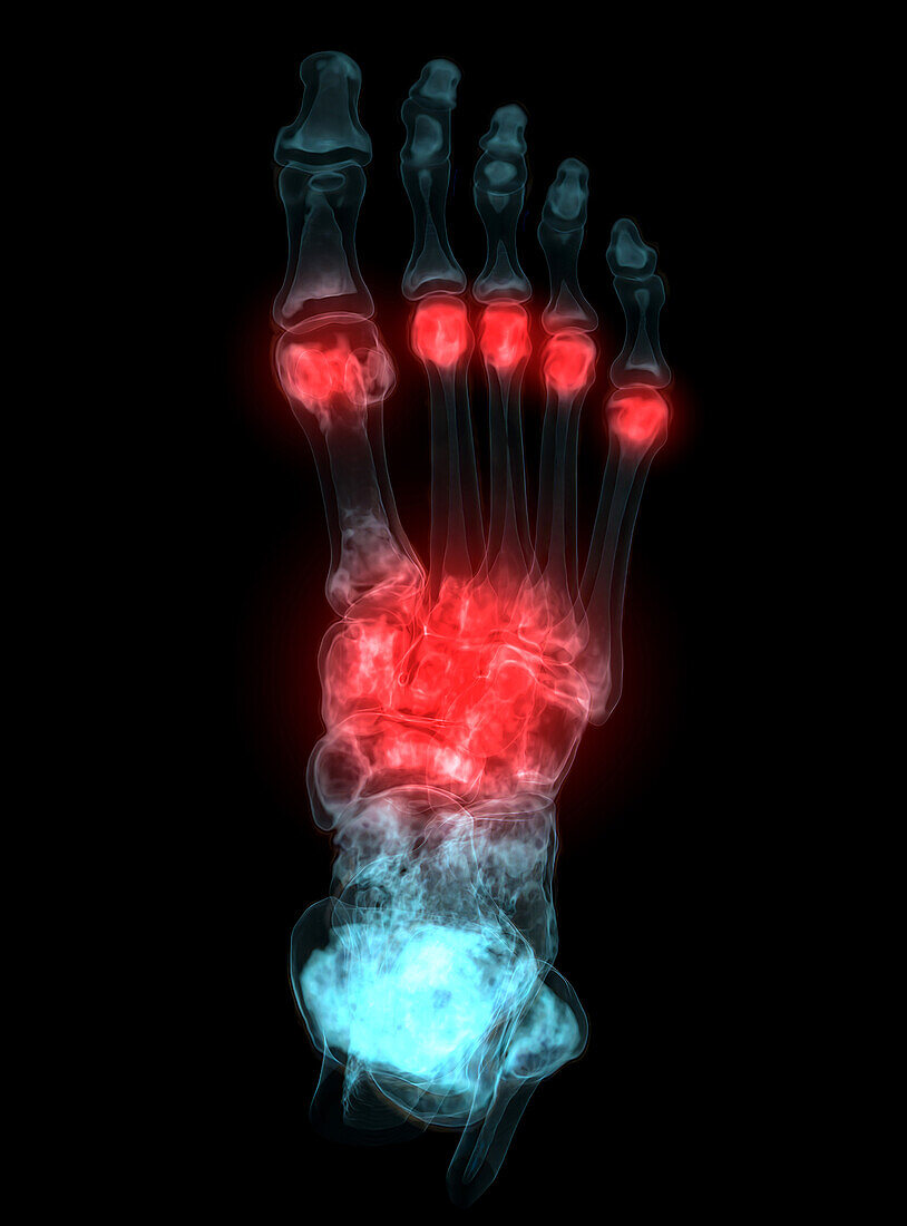 Foot pain, conceptual image