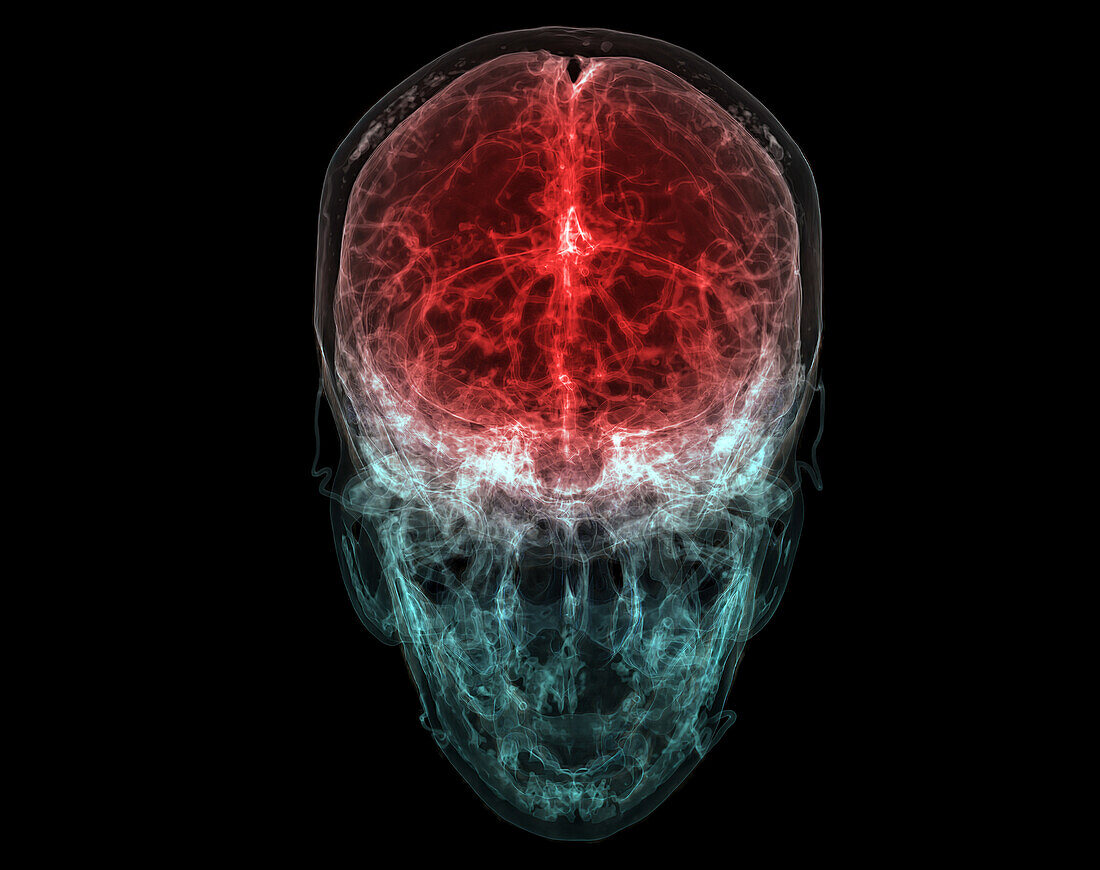 Brain blood vessels, CT scan