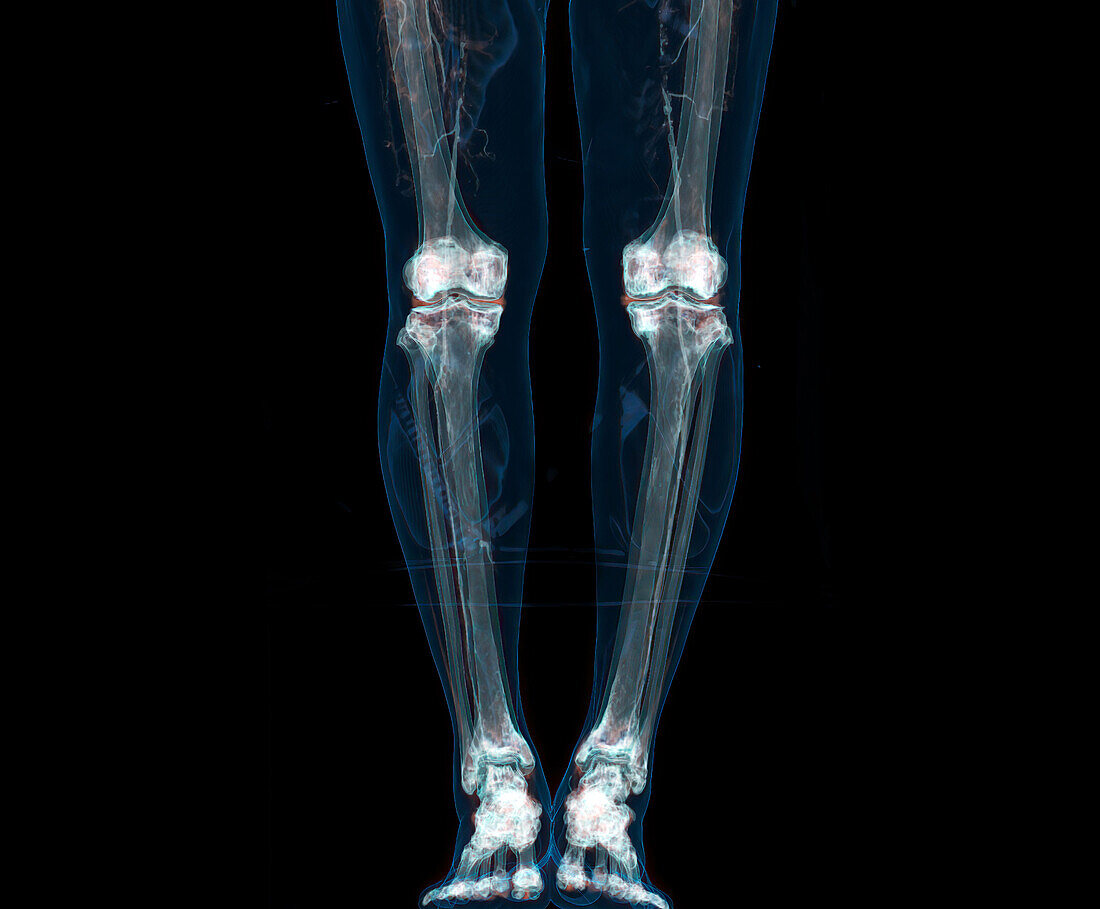 Legs, CT scan
