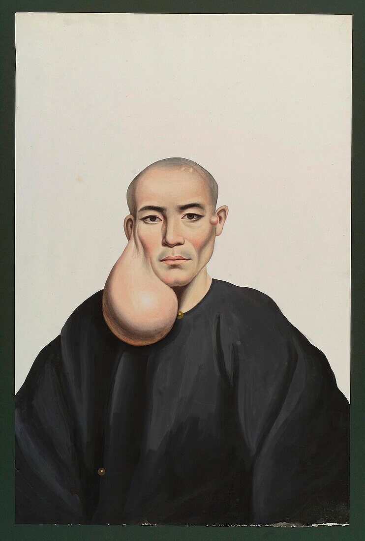 Man with facial tumour, 19th century illustration