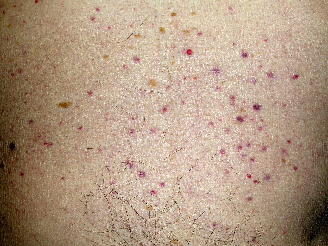 Granulomatosis with polyangiitis