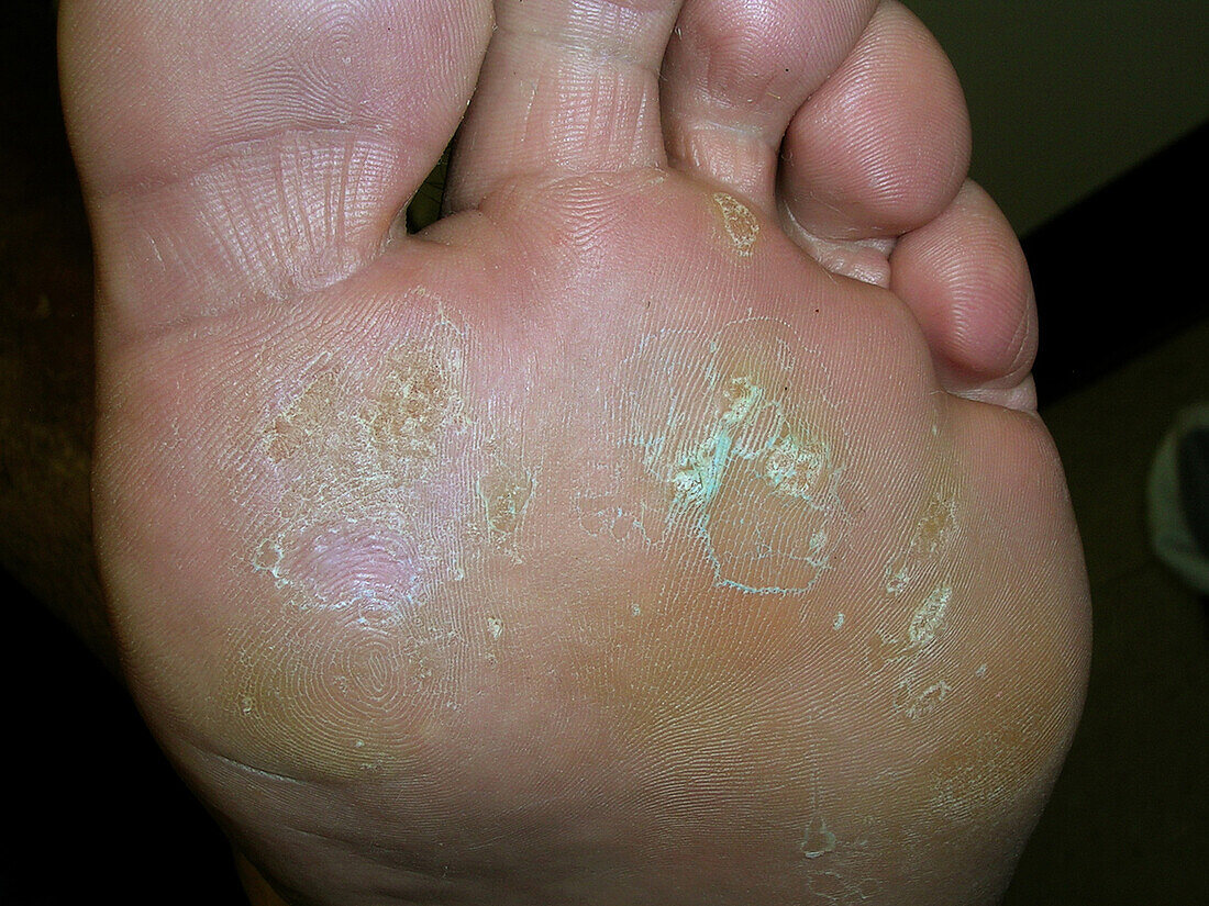 Warts after treatment