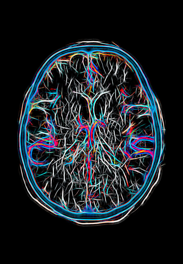 Cerebral arteries, CT scan