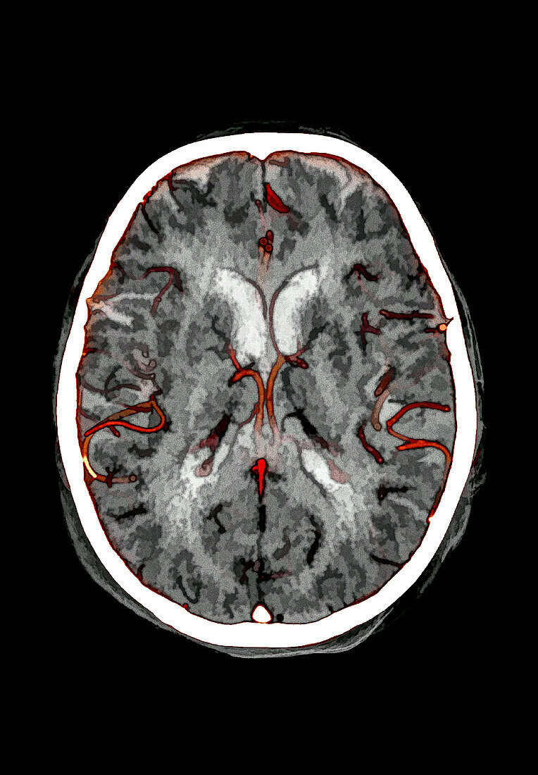 Cerebral arteries, CT scan