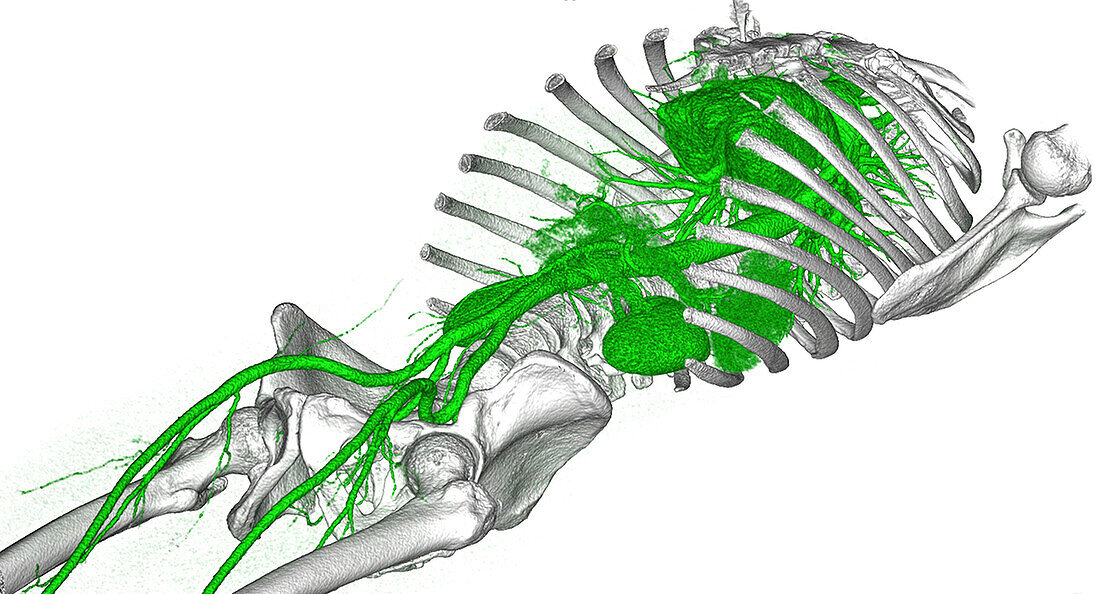Arteries of torso and upper legs, CT scan