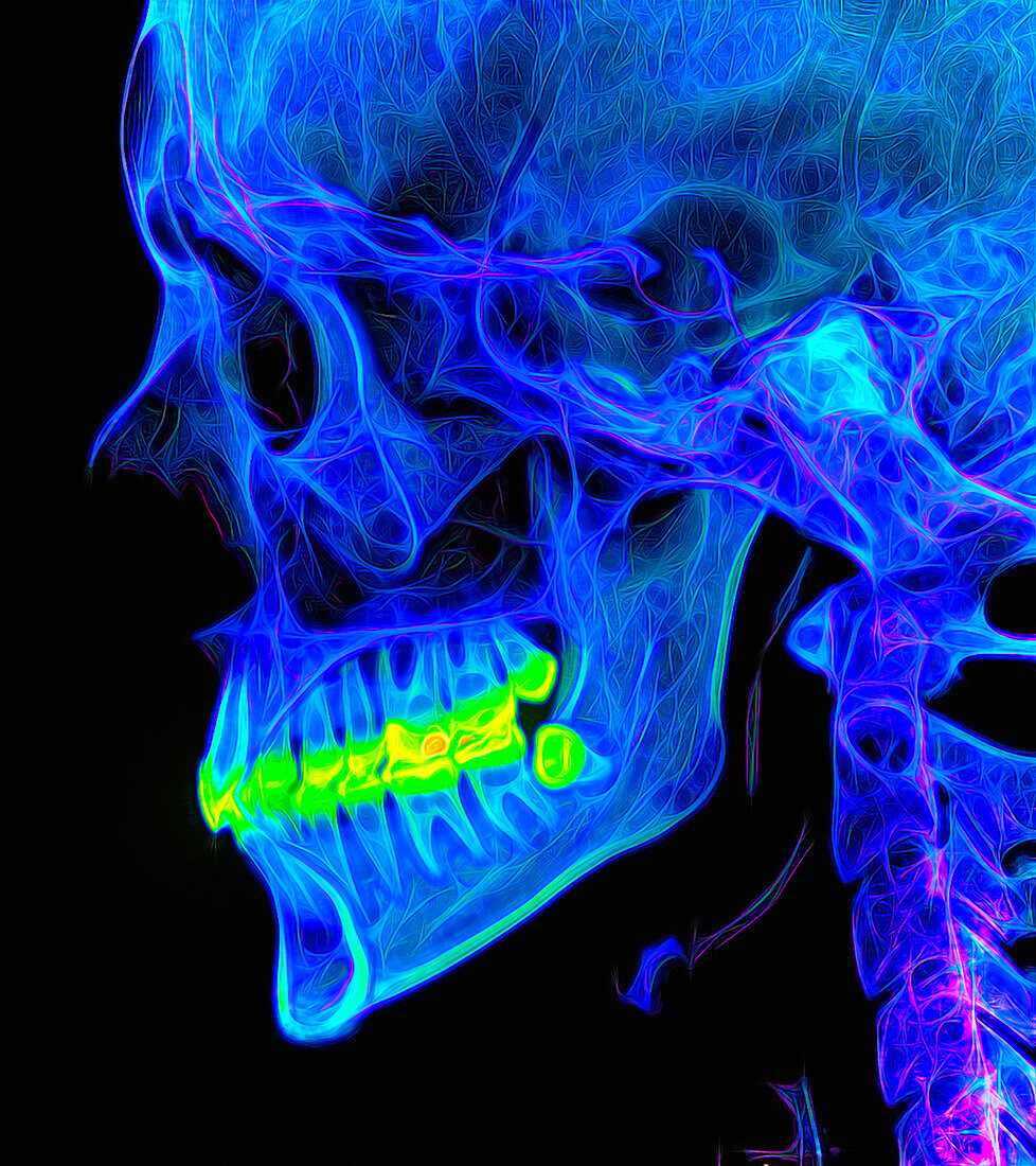 Head and neck bones, CT scan