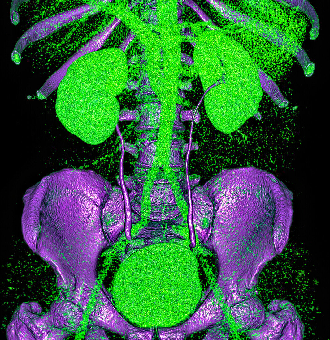 Urinary system, CT scan