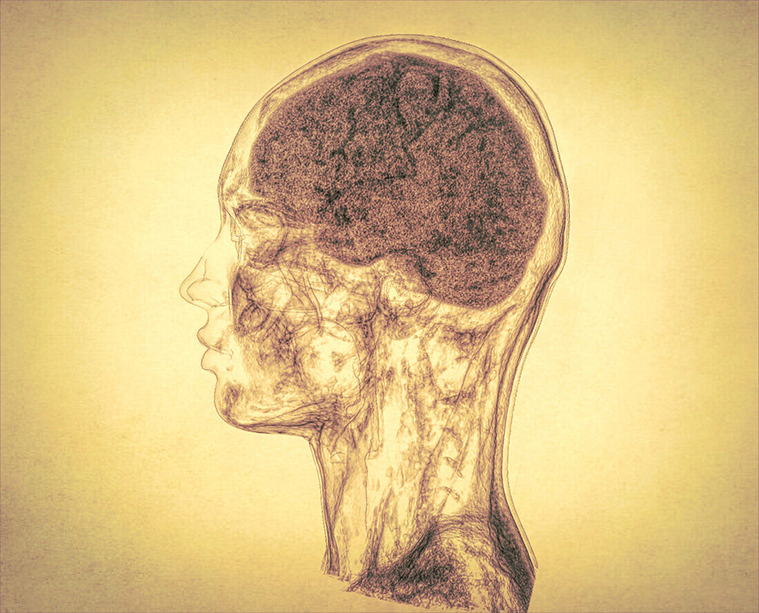 Head, neck and brain, CT scan