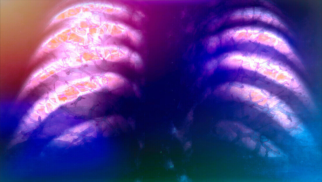 Ribs, CT scan