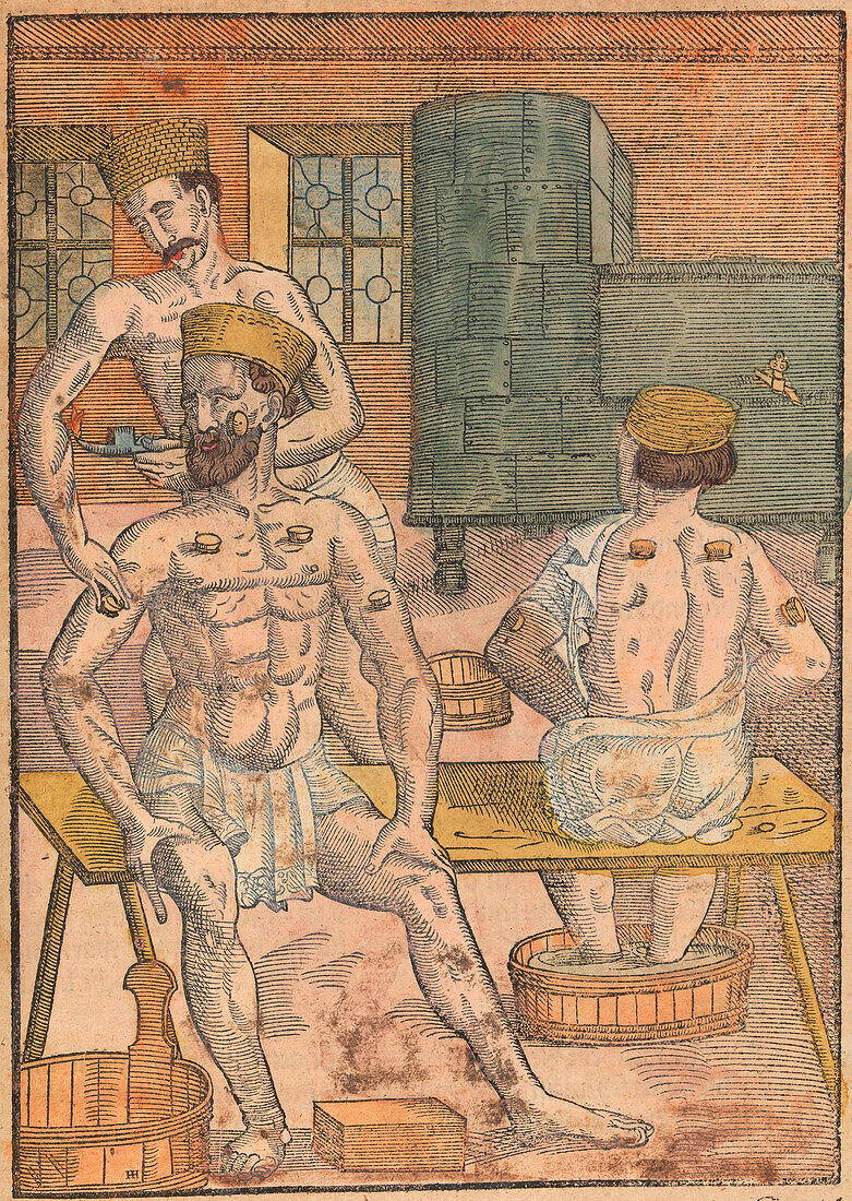 Cupping therapy, 16th century illustration