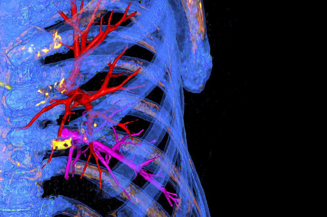 Healthy lung, CT scan