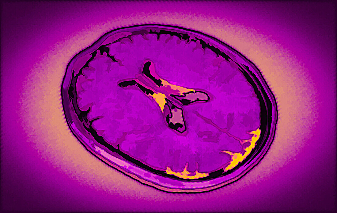 Healthy brain, CT scan