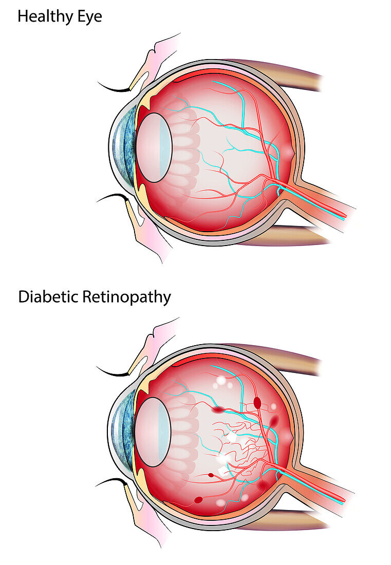 Healthy eye and diabetic retinopathy, illustration