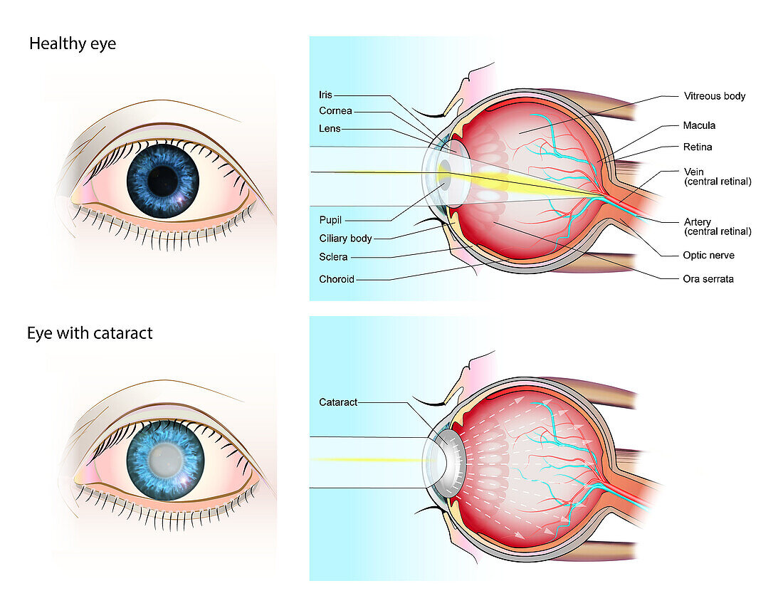 Normal eye and eye with cataract, illustration