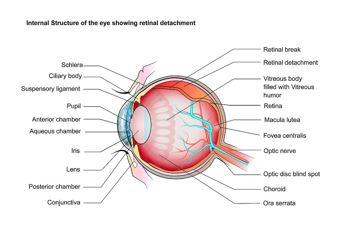 Retinal detachment, illustration