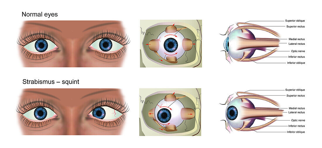 Normal eye and strabismus, illustration