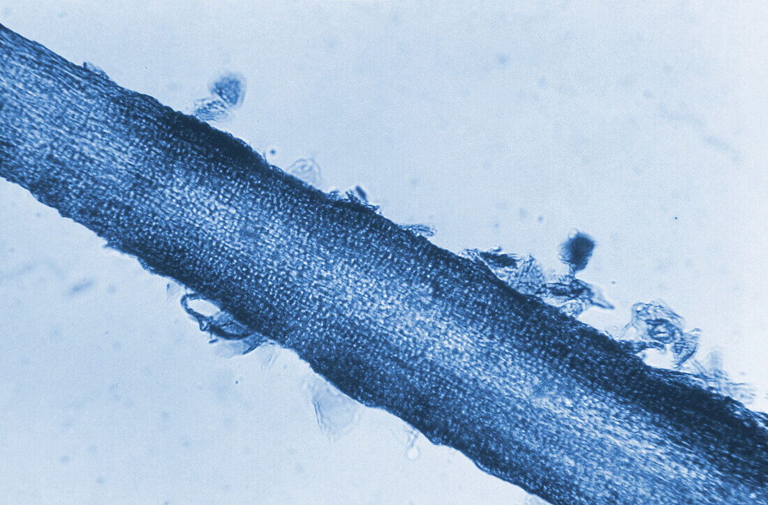 Ringworm infection, light micrograph