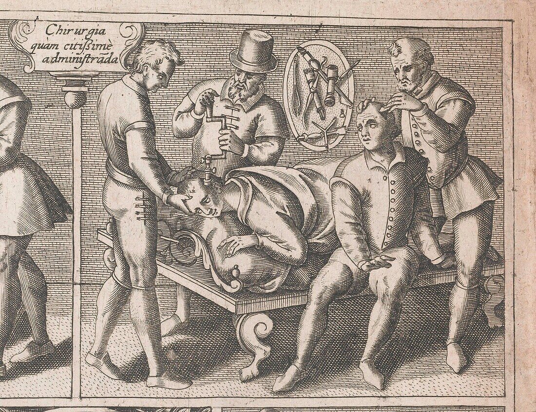Trepanation, 16th century illustration