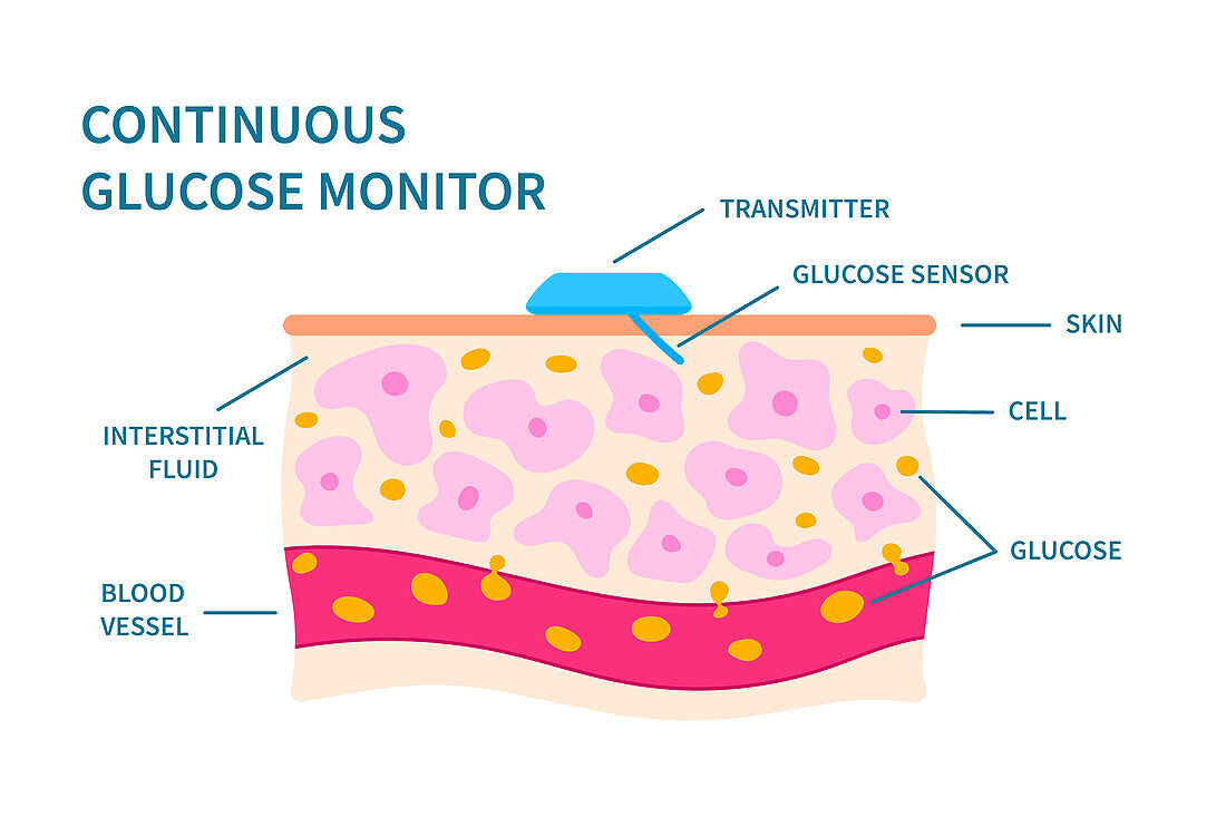 Continuous glucose monitor, illustration