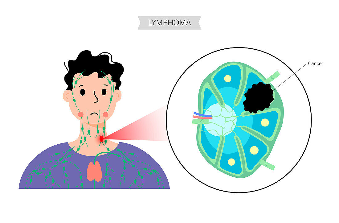 Lymphoma, conceptual illustration