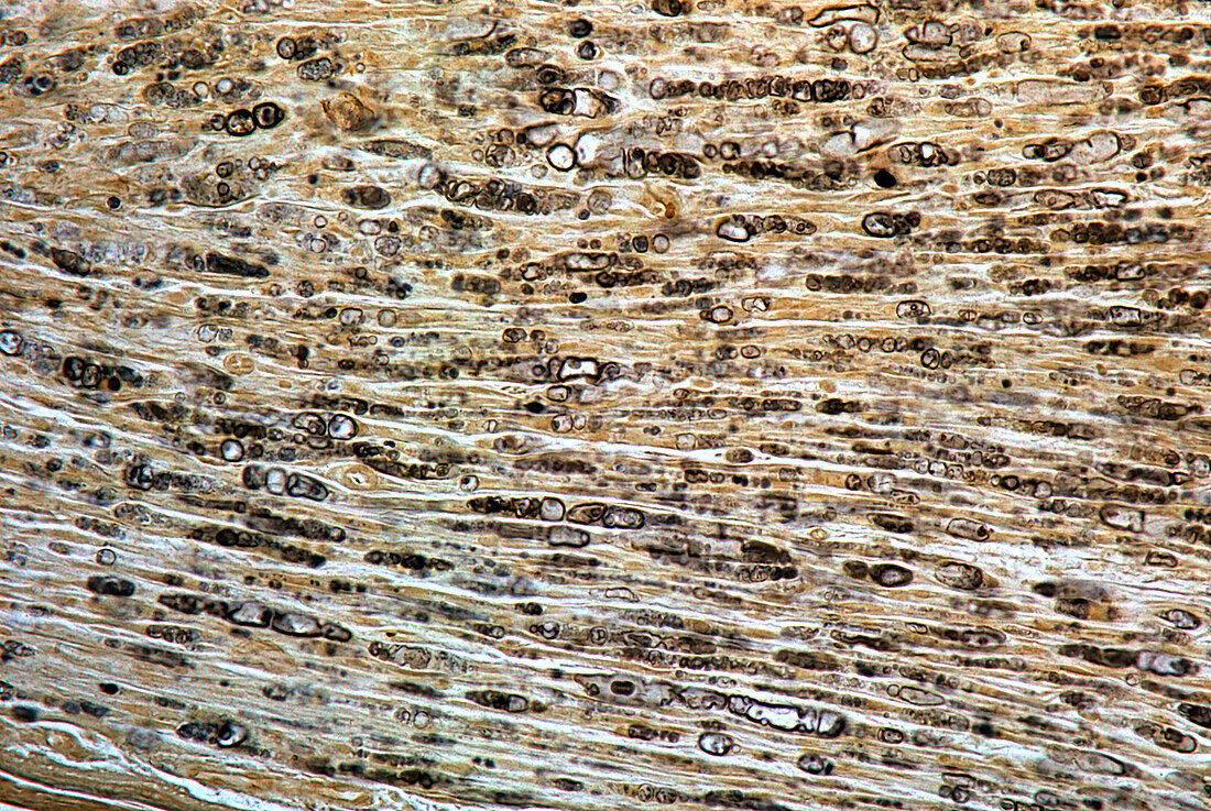 Damaged myelinated fibres, light micrograph
