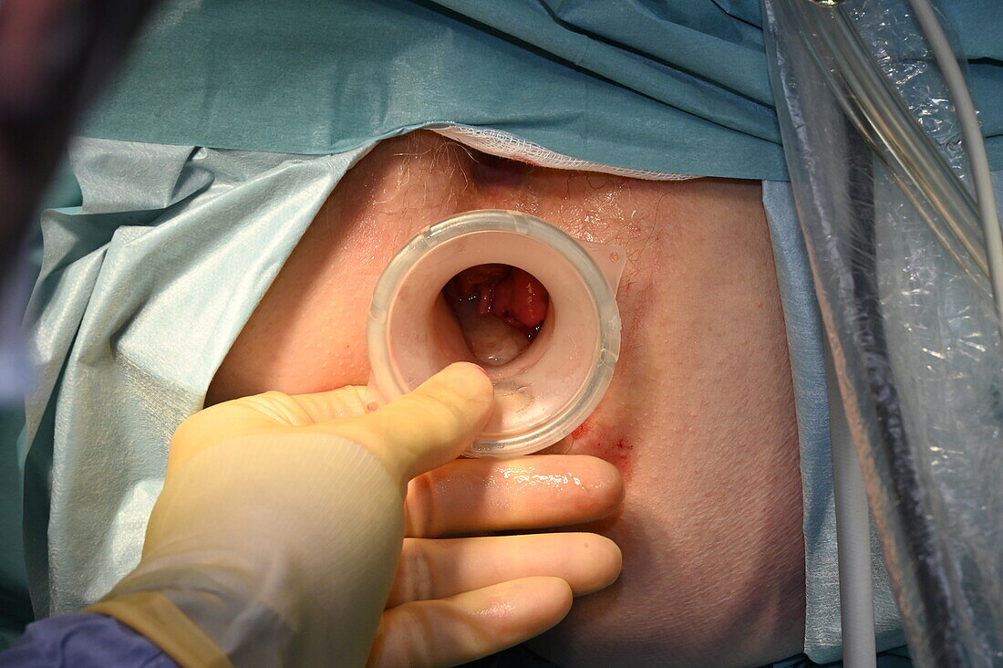 TAMIS tube insertion