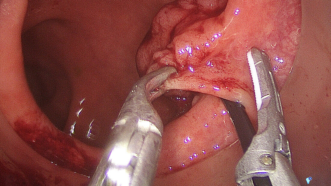 TAMIS polyp removal, endoscope view
