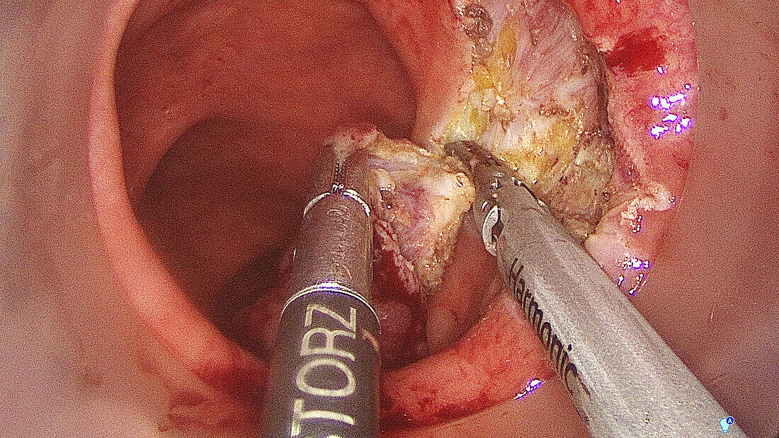 TAMIS polyp removal, endoscope view