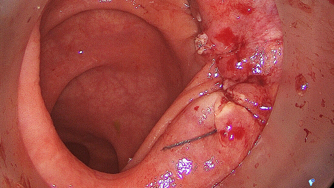 TAMIS polyp removal