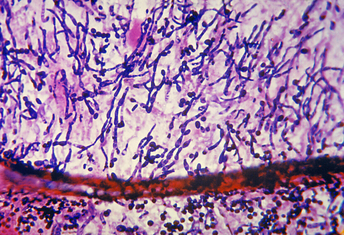 Candida albicans endocarditis, light micrograph