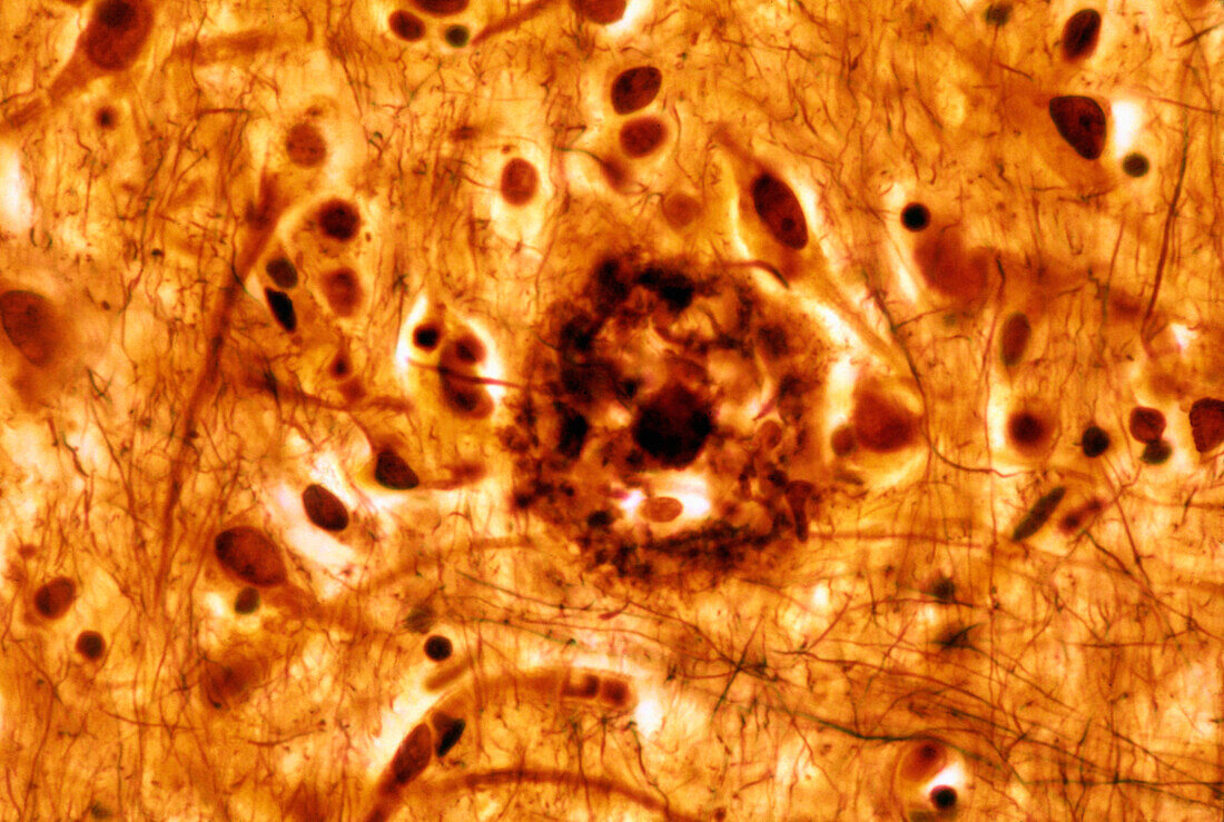 Senile plaque in cerebral cortex, light micrograph