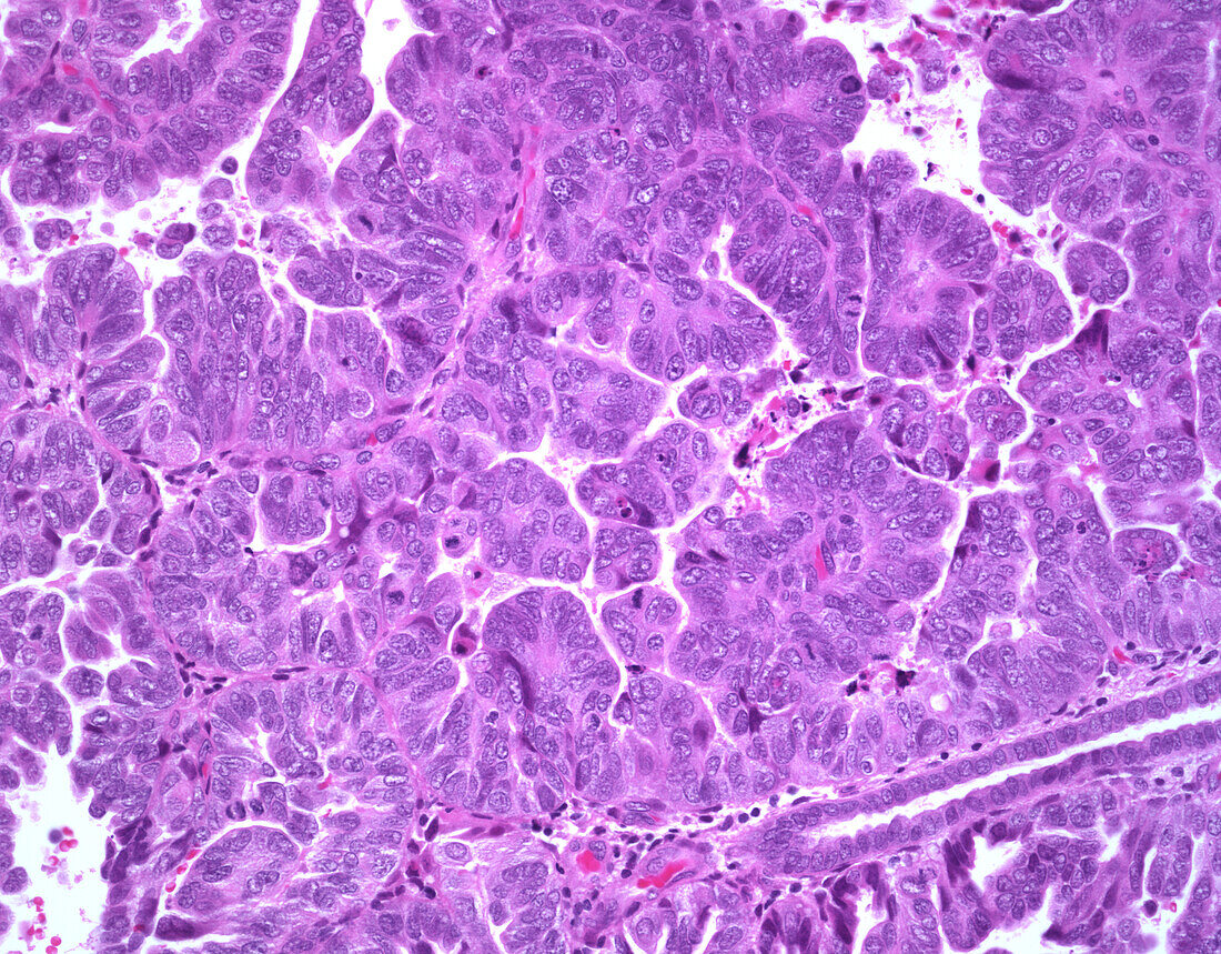 Serous carcinoma, light micrograph